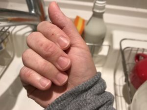 さかむけの原因は栄養不足？それとも…、予防法と治し方を解説